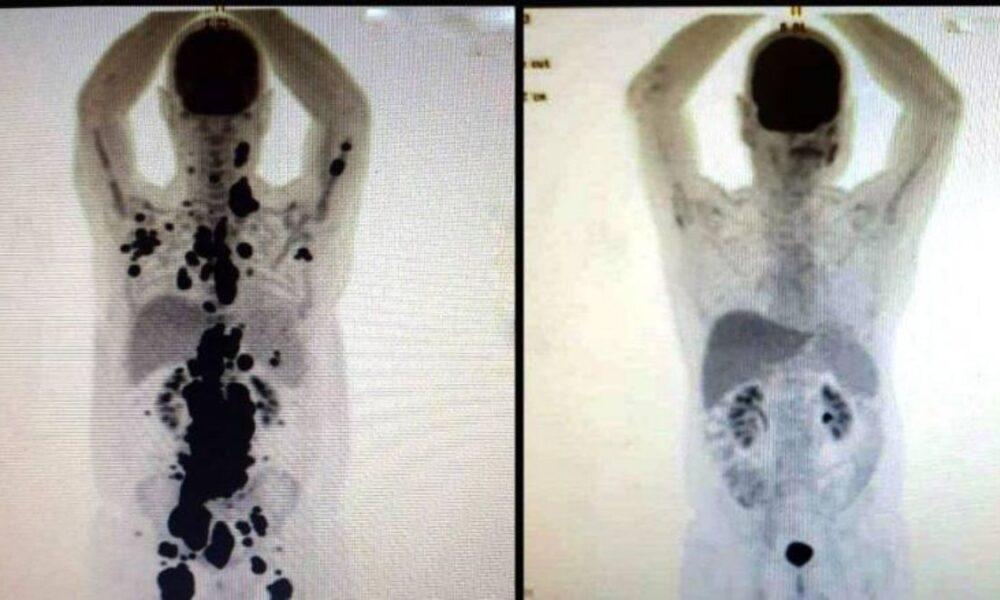 Inmunoterapia: Una esperanza para combatir definitivamente el cáncer.