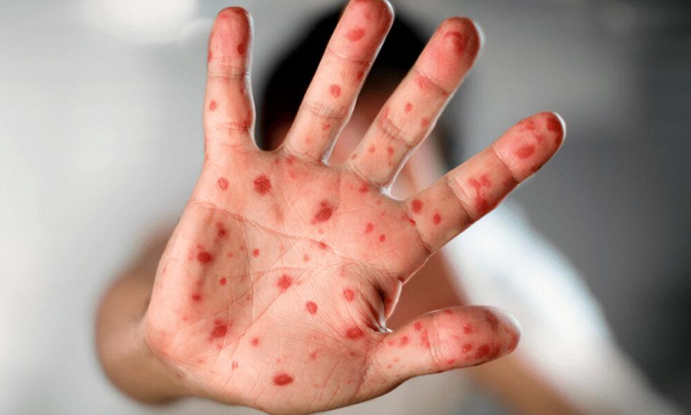 Venezuela implementa vigilancia epidemiológica por casos de viruela del mono
