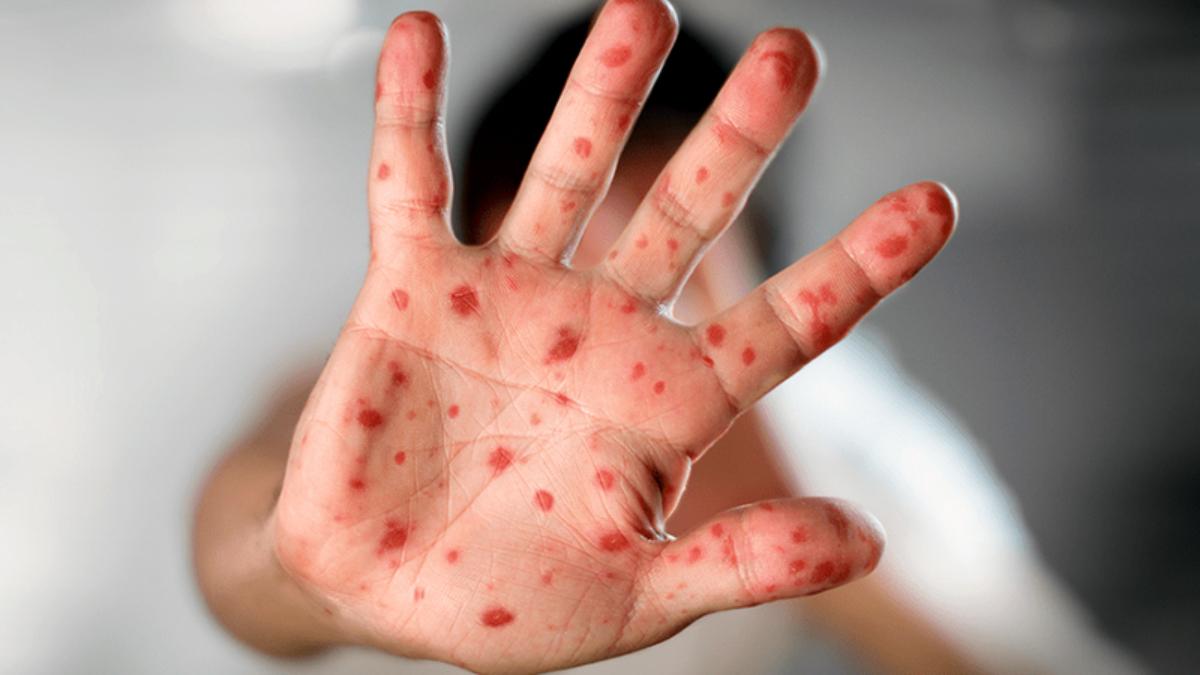 Venezuela implementa vigilancia epidemiológica por casos de viruela del mono